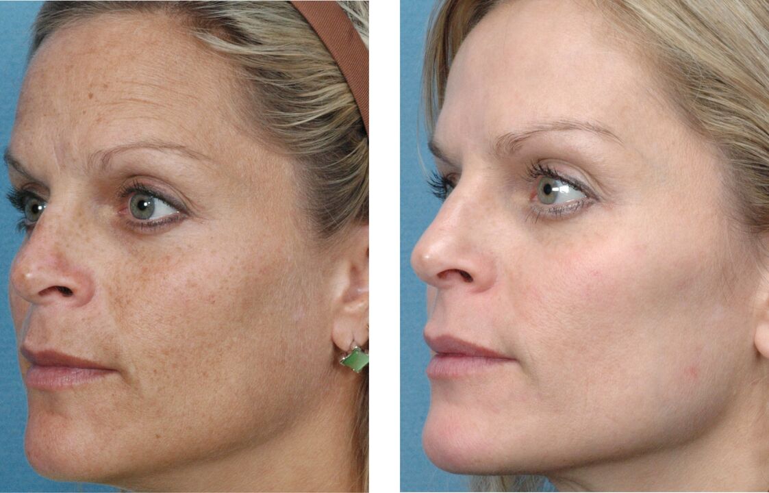 avant et après le rajeunissement de la peau photo 1