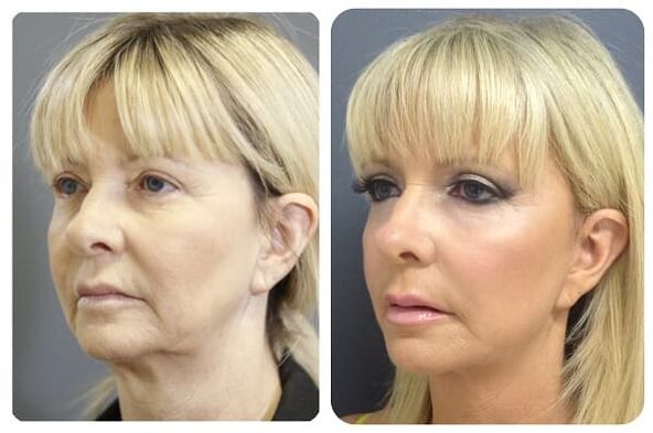 avant et après le rajeunissement de la peau avec photo raffermissant 2