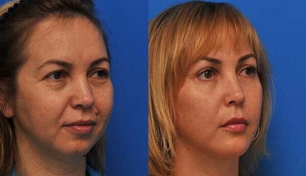 avant et après le rajeunissement de la peau avec raffermissement photo 1