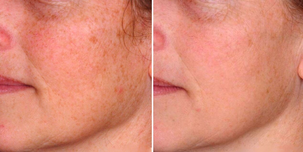Le résultat de la photothermolyse fractionnée est la réduction des taches de vieillesse sur la peau du visage. 