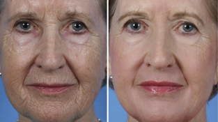 rajeunissement fractionné du visage avant et après les photos